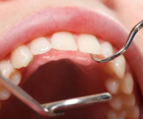 未来のトラブルを未然に防ぐ予防歯科