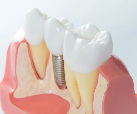 安全・確実なインプラント治療