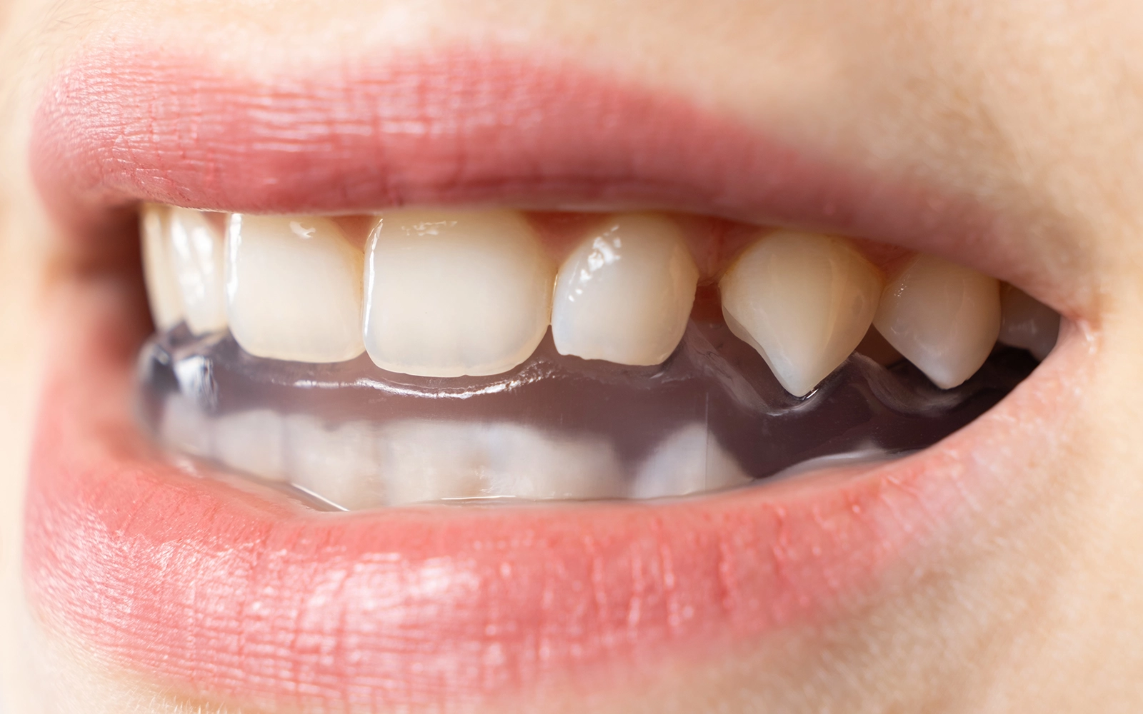 マウスピース治療