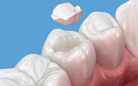 セラミックインレー（詰め物）