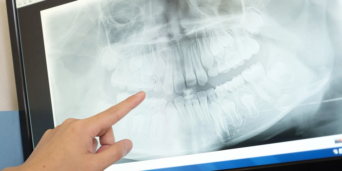 根管治療が必要なケース